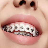 ارتودنسی در مطب دکتر خلیل عباسی