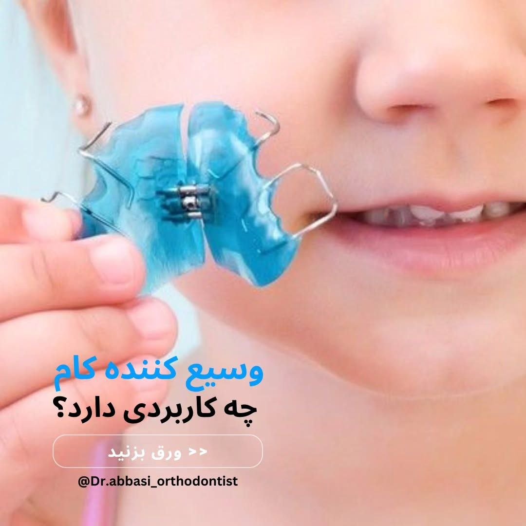 وسیع کننده کام